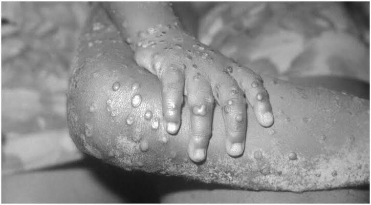 বিশ্বব্যাপী মাঙ্কিপক্স আক্রান্তের সংখ্যা ২০০ ছাড়িয়েছে : ইইউ ডিজিজ এজেন্সি