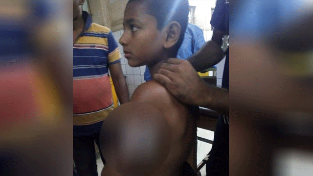 ‘ধাক্কা লাগায়’গরম তেলে শিশুর হাত ঝলসে দিলেন বাবুর্চি